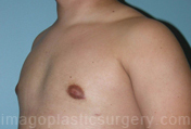 after left angle view gynecomastia of male patient 3276