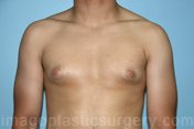 before front view gynecomastia of male patient 3281