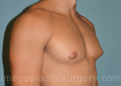 before right angle view gynecomastia of male patient 3286