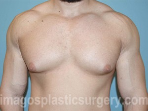 before front view gynecomastia of male patient 3292