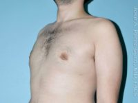 after left angle view gynecomastia of male patient 3303
