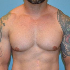 before front view gynecomastia of male patient 3323