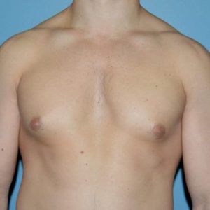 before front view gynecomastia of male patient 3328