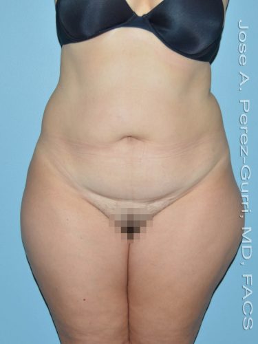 before front view liposuction of female patient 3609