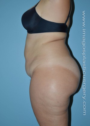 before left side view liposuction of female patient 3609