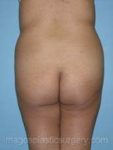 before back view liposuction of female patient 3614