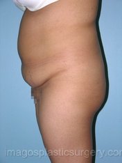 before left side view liposuction of female patient 3614