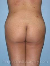 after back view liposuction of female patient 3614