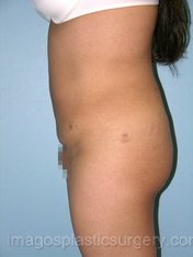 after left side view liposuction of female patient 3614