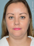before front view liposuction of female patient 3619