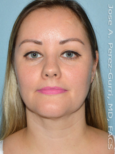 after front view liposuction of female patient 3619