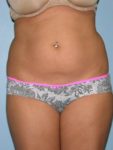 before front view liposuction of female patient 3625