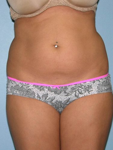 before front view liposuction of female patient 3625