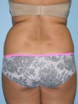 before back view liposuction of female patient 3625