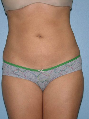 after front view liposuction of female patient 3625