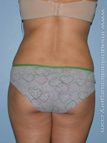after back view liposuction of female patient 3625