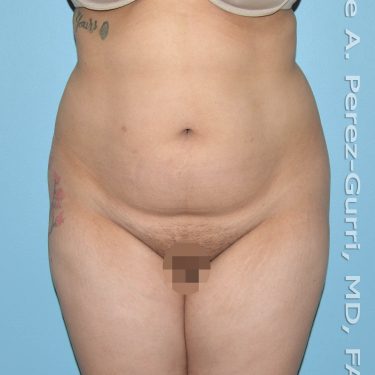 before front view liposuction of female patient 3644