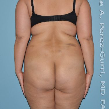 before back view liposuction of female patient 3655