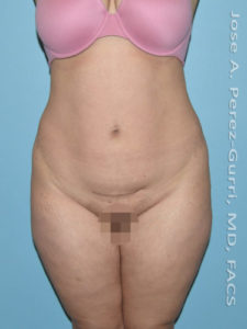 before front view liposuction of female patient 3672