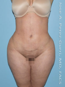 after front view liposuction of female patient 3672