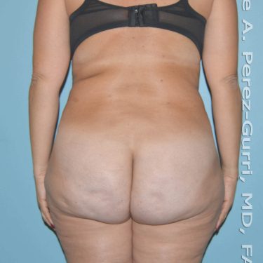 before back view liposuction of female patient 3681