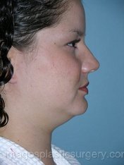 before right side view liposuction of female patient 3694