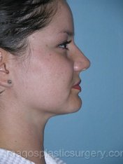 after right side view liposuction of female patient 3694