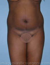 Before liposuction front view female patient case 3737