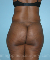 Before liposuction back view female patient case 3737