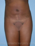 After liposuction front view female patient case 3737