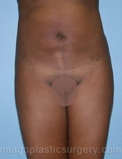 After liposuction front view female patient case 3737