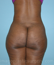 Back liposuction back view female patient case 3737