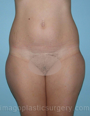 Before liposuction front view female patient case 3747