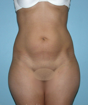 Before liposuction front view female patient case 3750