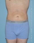 After liposuction front view male patient case 3760