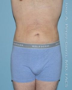 After liposuction front view male patient case 3760