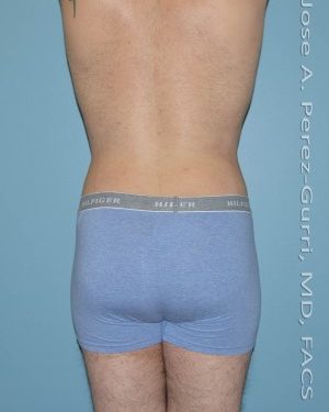 After liposuction back view male patient case 3760