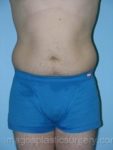 Before liposuction front view male patient case 3766