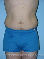 Before liposuction front view male patient case 3766
