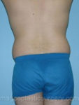 Before liposuction back view male patient case 3766