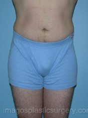 After liposuction front view male patient case 3766