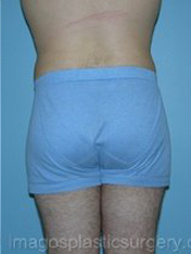 After liposuction back view male patient case 3766