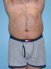 Before liposuction front view male patient case 3771