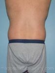 Before liposuction back view male patient case 3771