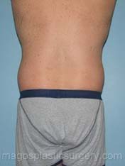 Before liposuction back view male patient case 3771