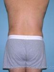 After liposuction back view male patient case 3771