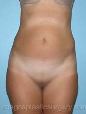 Before liposuction female patient front view case 3777