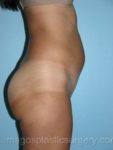 Before liposuction right side view female patient case 3777