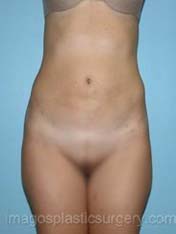Before liposuction front view female patient case 3777