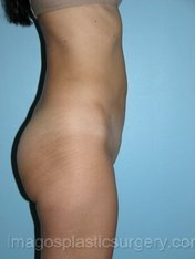 After liposuction right side view female patient case 3777